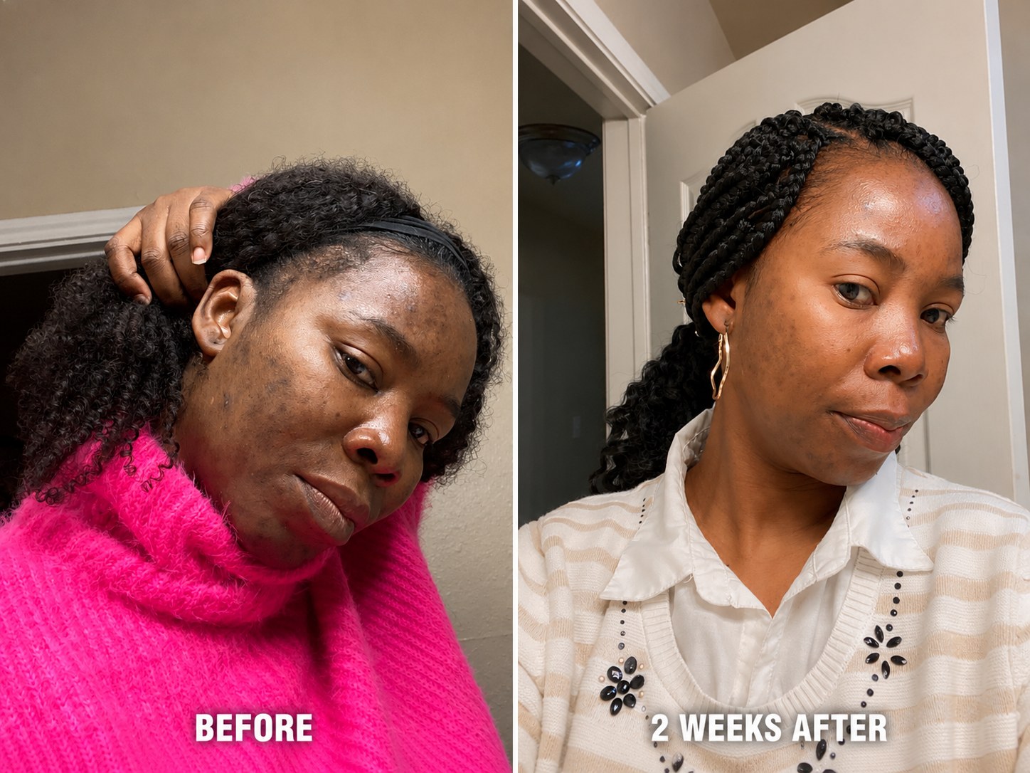 Nancy's real result — before and 2 weeks after using the Moringa Radiance Ritual